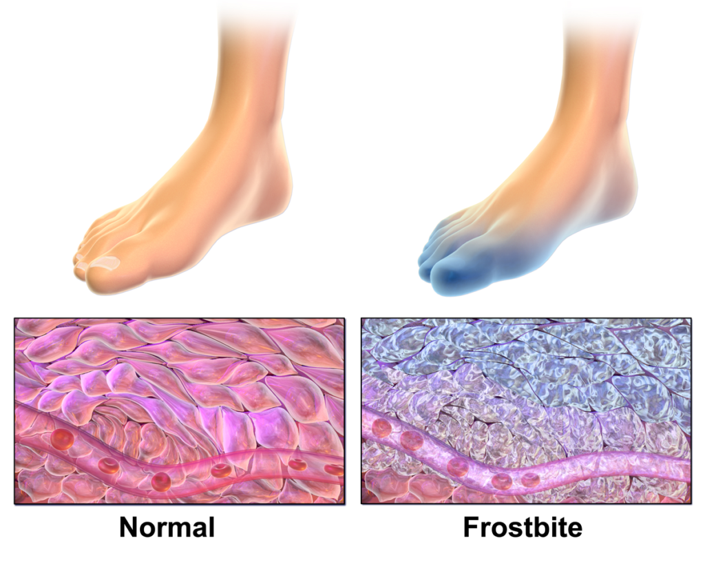 hypothermia, frostbite, hypothermia and frostbite, snowboarding safety